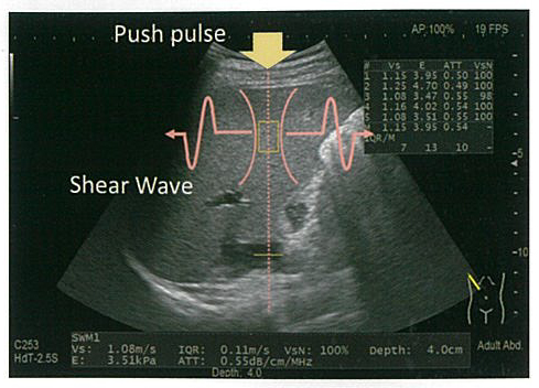 Shear Wave Measurement（SWM）